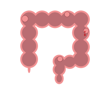 colonpolyp.png